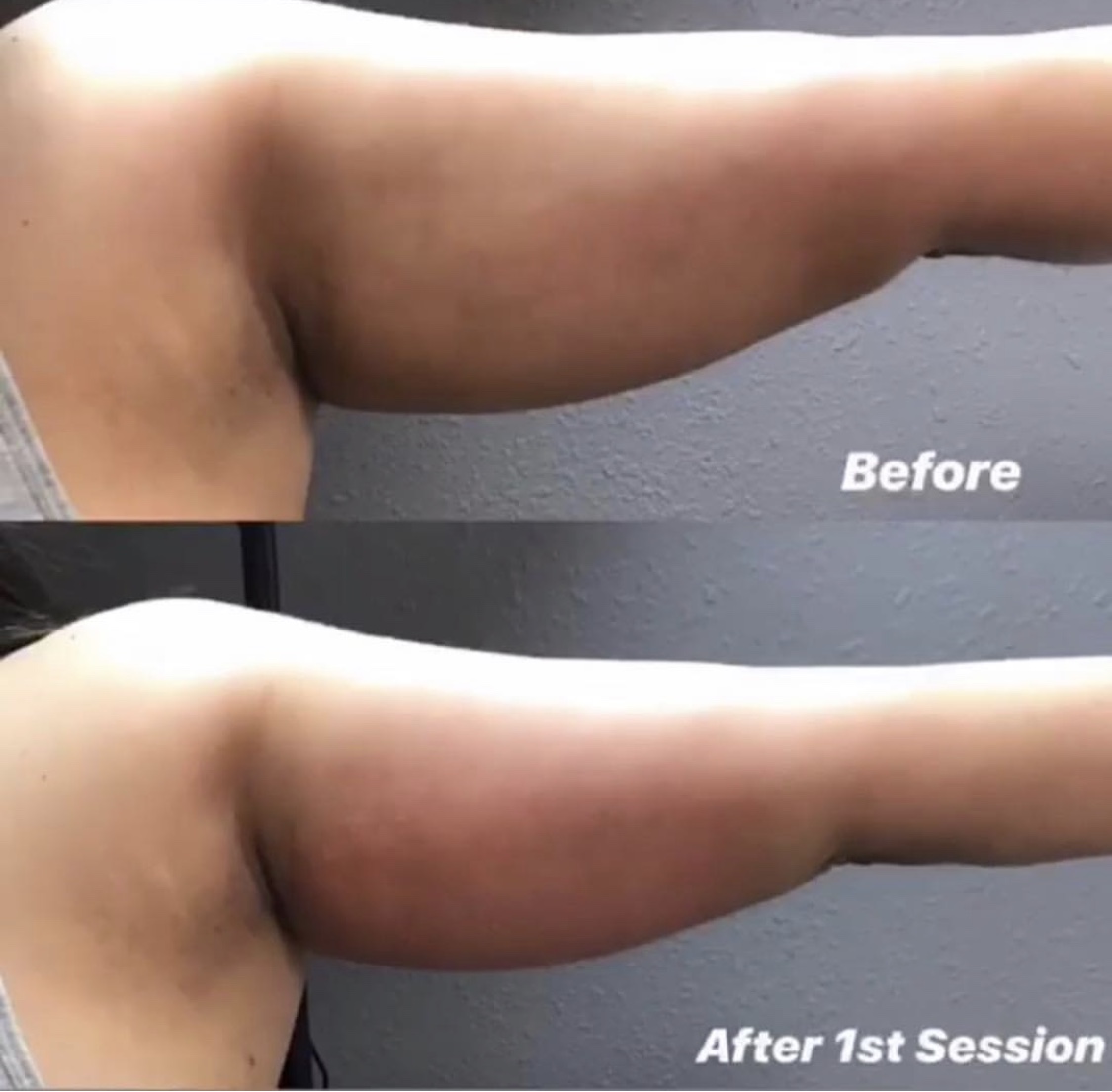 67e6a9a5c1e0f8221673844d_67da384d11000731ae0c5df2_1-Shape-arm Body Sculpting - J.Bentley Hair Studio Day Spa