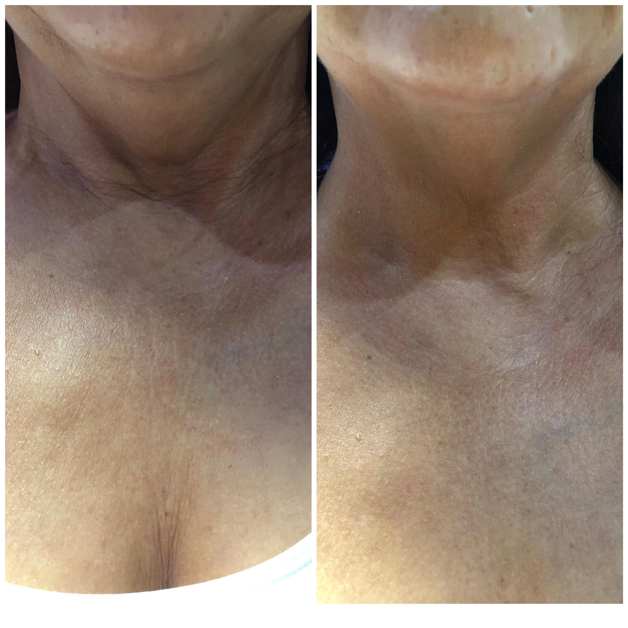 67e6a9bae97dbf93014fda04_67da386d28864e3f12d588e7_2-double-chin-Shape-2 Body Sculpting - J.Bentley Hair Studio Day Spa
