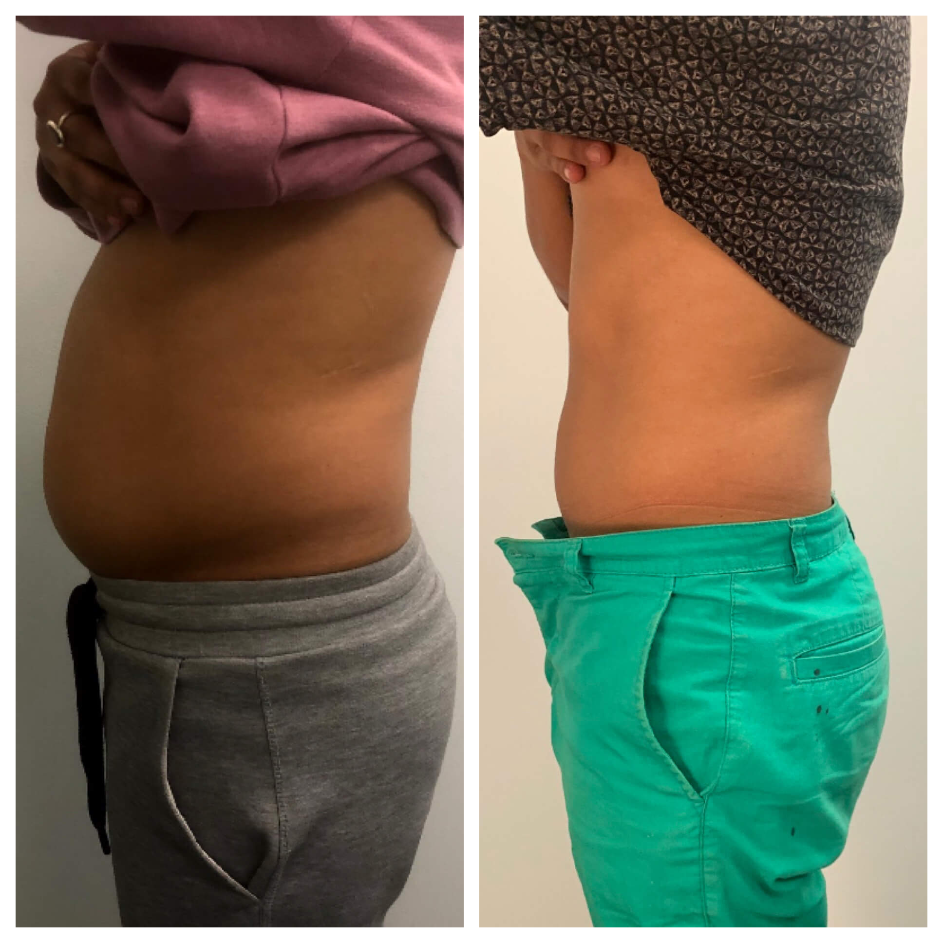 67e6a9d55b744a37d8df124e_67da387ffaf4e704b6d96345_8-Shape-treatments-give-credit-to-thrivecryostudio Body Sculpting - J.Bentley Hair Studio Day Spa