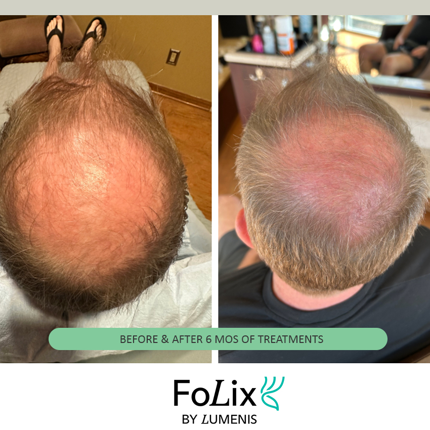 FOLIX%20RON Folix Hair Restoration - J.Bentley Hair Studio Day Spa