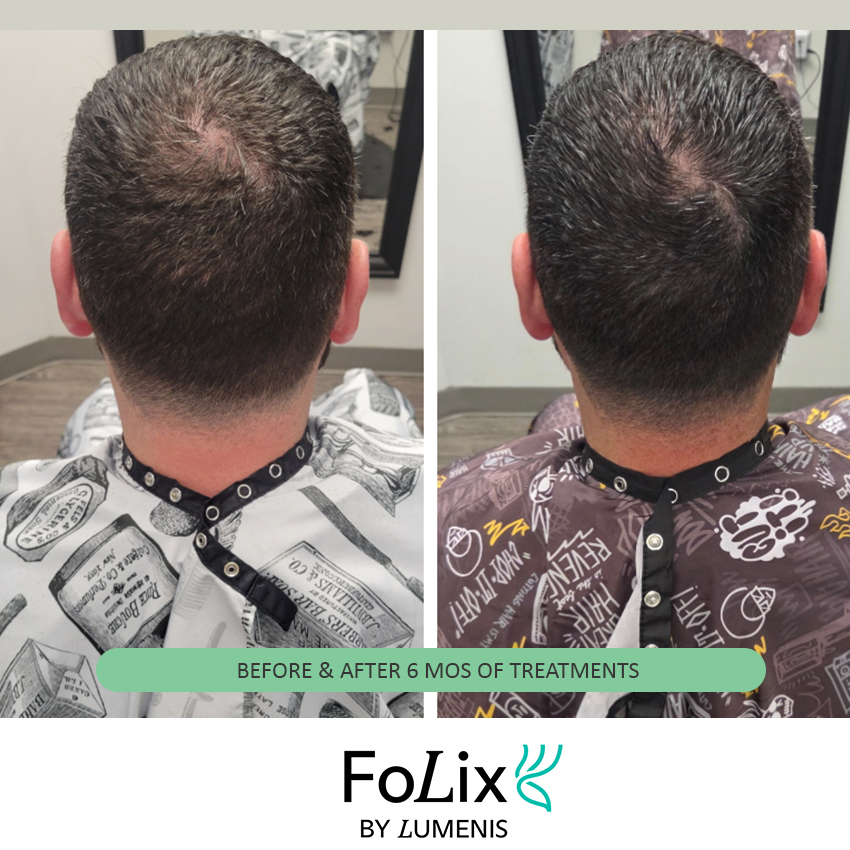 FOLIX%20nick Folix Hair Restoration - J.Bentley Hair Studio Day Spa