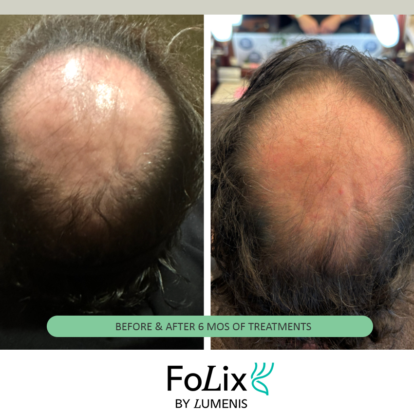 folix%20dave Folix Hair Restoration - J.Bentley Hair Studio Day Spa