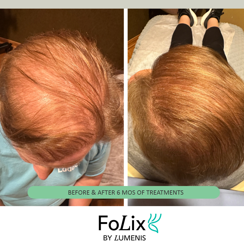 folix%20kathy Folix Hair Restoration - J.Bentley Hair Studio Day Spa