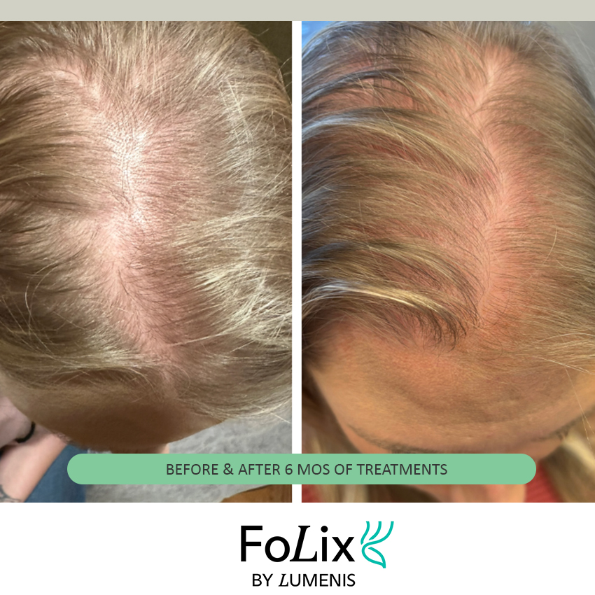 folix%20katie Folix Hair Restoration - J.Bentley Hair Studio Day Spa
