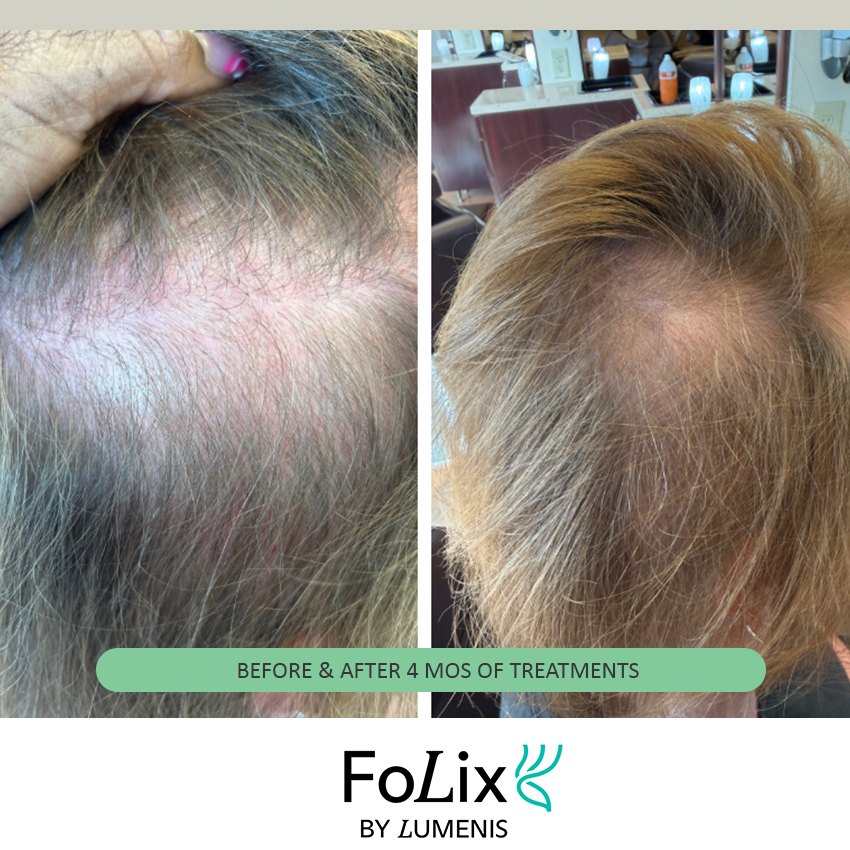 folix%20nancy Folix Hair Restoration - J.Bentley Hair Studio Day Spa