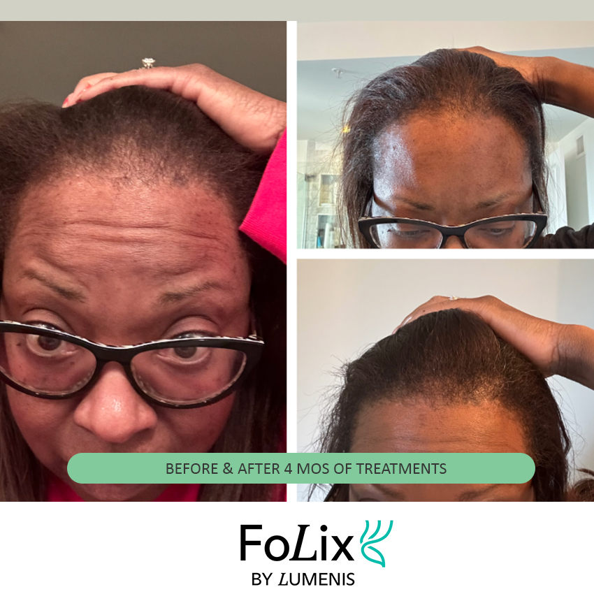 folix%20tyra Folix Hair Restoration - J.Bentley Hair Studio Day Spa
