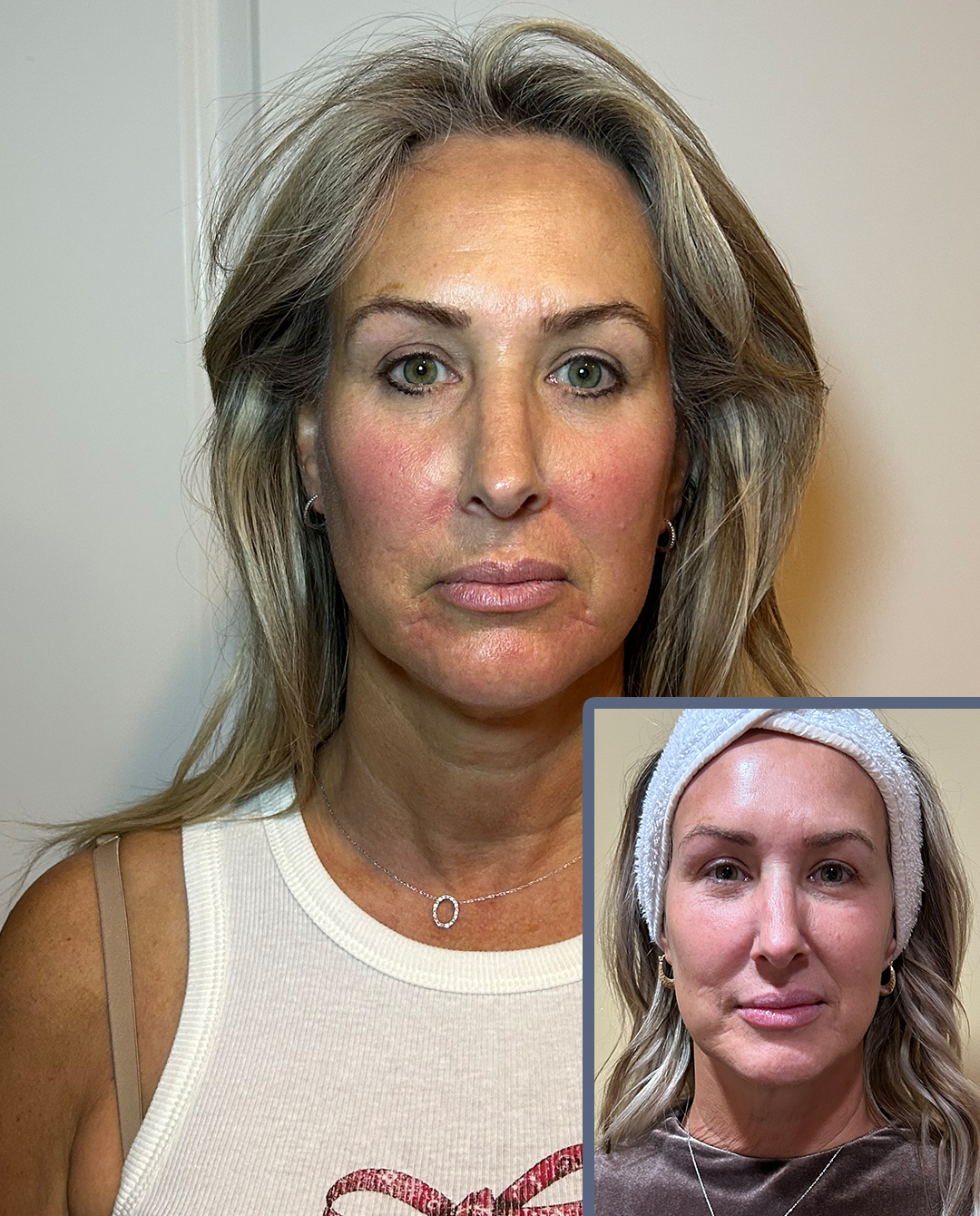 michelle-trilift Trilift Face Lift - J.Bentley Hair Studio Day Spa