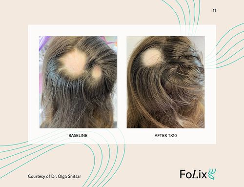 67e5a4122664b9dba5fb893c_67da3a0a533d703e969c09ec_woman%20extreme%20ba-p-500 Folix Hair Restoration - J.Bentley Hair Studio Day Spa