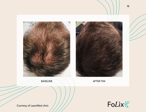 67e5a41263f8b884c089c307_67da39d699194f07c0ec9d99_male_medium%20ba-p-500 Folix Hair Restoration - J.Bentley Hair Studio Day Spa