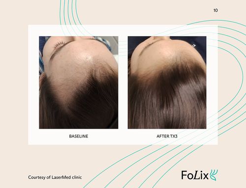 67e5a4128594c44228a27475_67da3a135c0c2e4815440094_woman%20hairline-p-500 Folix Hair Restoration - J.Bentley Hair Studio Day Spa