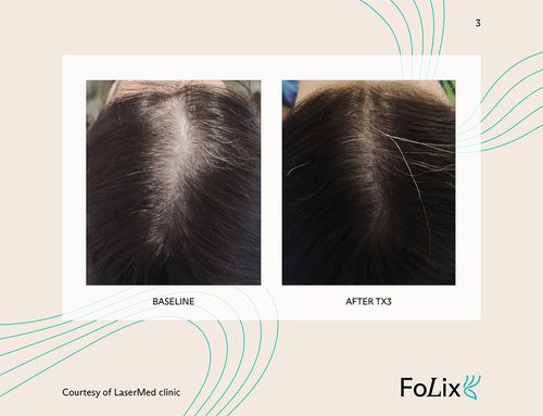 67e5a412df902bb2cff0e124_67da3a2708fd9ca0e56f2562_women%20mild%20ba-p-500 Folix Hair Restoration - J.Bentley Hair Studio Day Spa