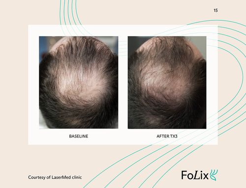 67e5a413b1d96dfc61e25a1c_67da39fa29e81af13c3a3518_man%20severe%20ba-p-500 Folix Hair Restoration - J.Bentley Hair Studio Day Spa