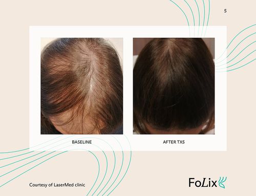 67e5a41400b9501b8a062e99_67da3a1e089c1860cba0c95d_woman%20severe-p-500 Folix Hair Restoration - J.Bentley Hair Studio Day Spa