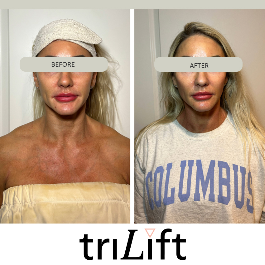 trilift%20ba1 Trilift Face Lift - J.Bentley Hair Studio Day Spa