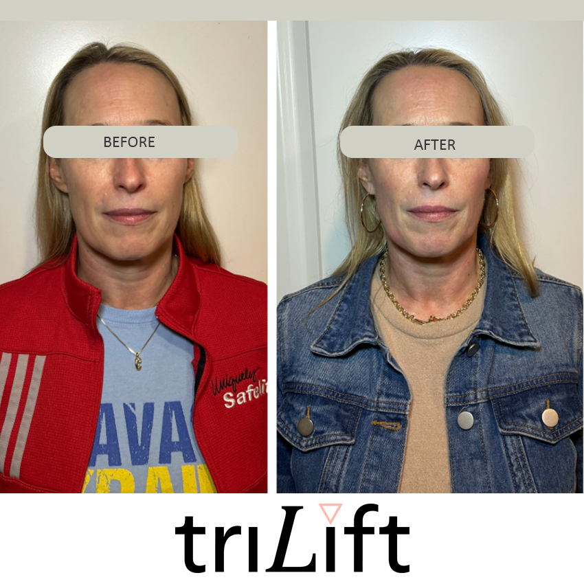 trilift%20christina Trilift Face Lift - J.Bentley Hair Studio Day Spa