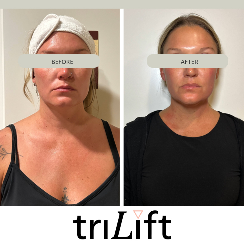 trilift%20kaila Trilift Face Lift - J.Bentley Hair Studio Day Spa