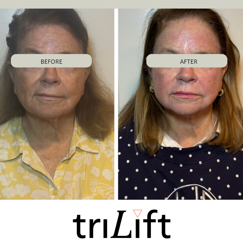 trilift%20kathleen Trilift Face Lift - J.Bentley Hair Studio Day Spa