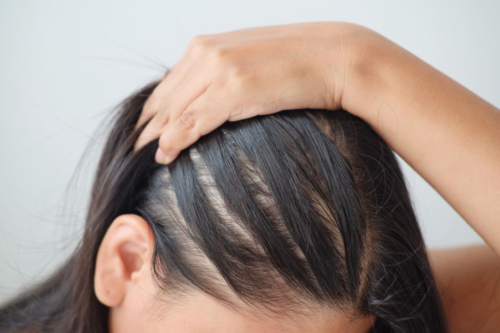 shutterstock_1740926255-scalp-54697fed Folix Hair Restoration - J.Bentley Hair Studio Day Spa
