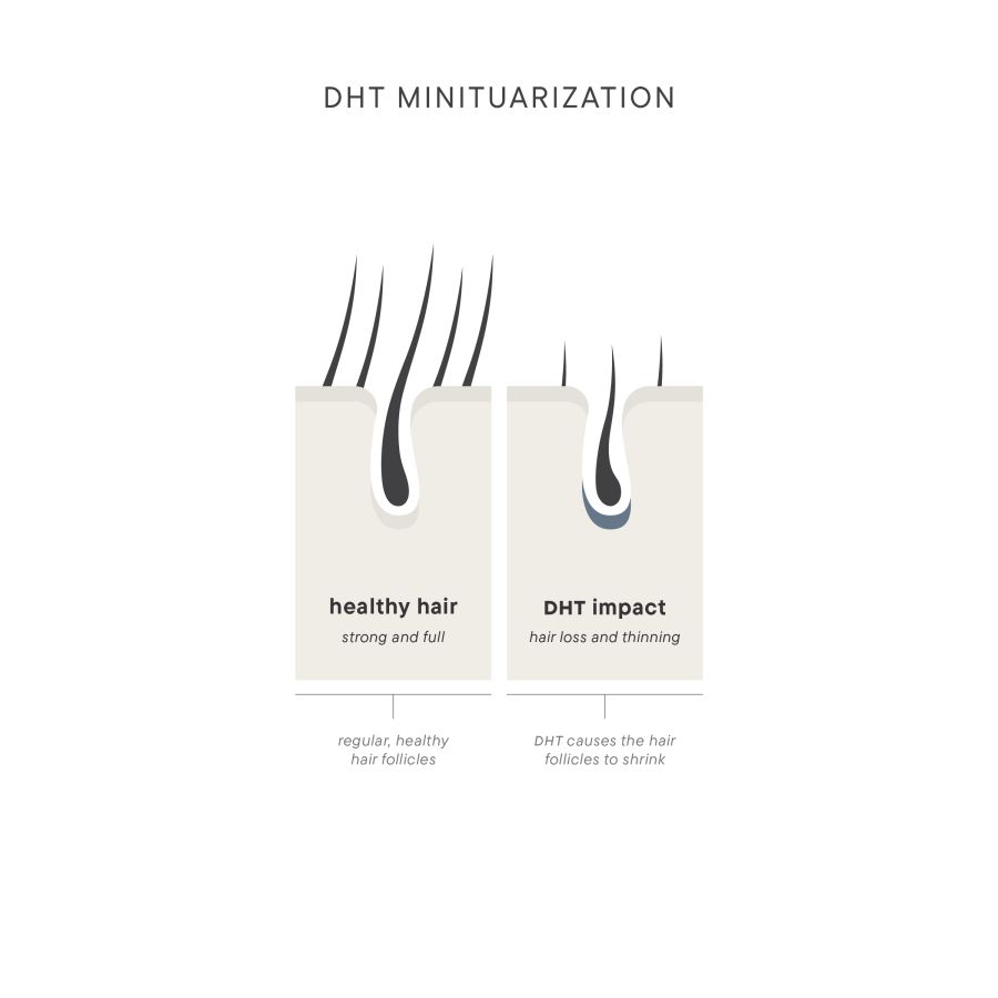 DHT%20Infographic%20ScalpTherapy%20%20For%20Him-b52a7eb9 Folix Hair Restoration - J.Bentley Hair Studio Day Spa