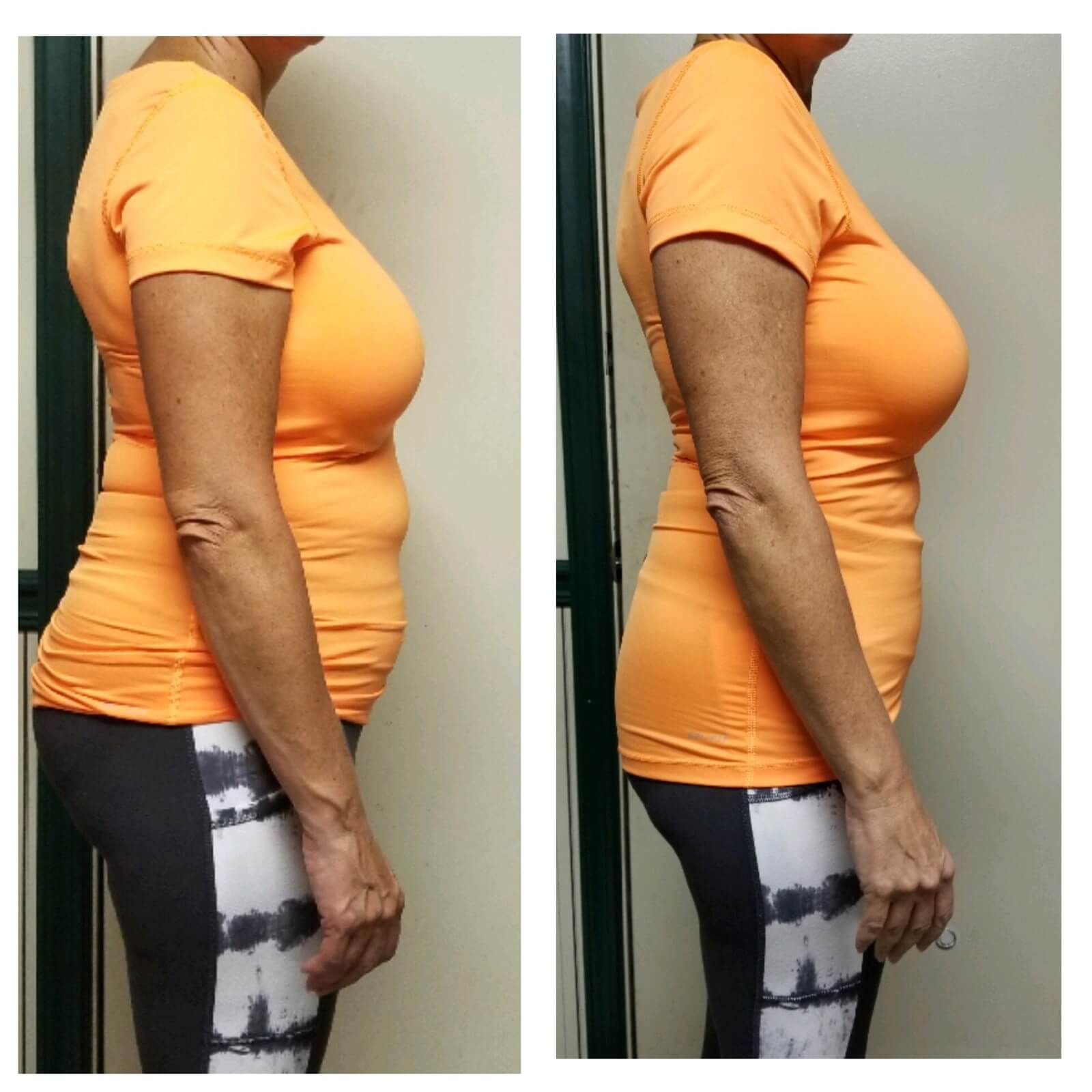 67e6a9d4dfbd2038919f552b_67da3888c597ad1aaccbd542_Abdomen-Side-no-logo-Before-After-6-0014ebc3 Body Sculpting - J.Bentley Hair Studio Day Spa | Powell, OH