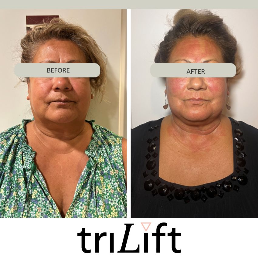 trlifit%20cruz-3287be2f Trilift Face Lift - J.Bentley Hair Studio Day Spa | Powell, OH