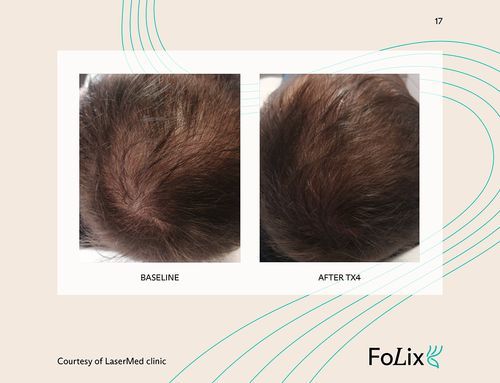 67e5a412384ad46614e8aaea_67da39e868660bfefa9311b4_male_mild%20ba-p-500-8c14a527 Folix Hair Restoration - J.Bentley Hair Studio Day Spa | Powell, OH