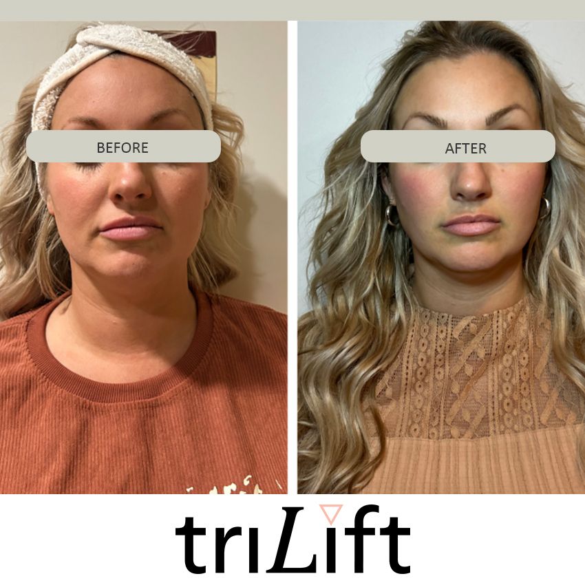 trilift%20marybeth-924c98b3 Trilift Face Lift - J.Bentley Hair Studio Day Spa | Powell, OH