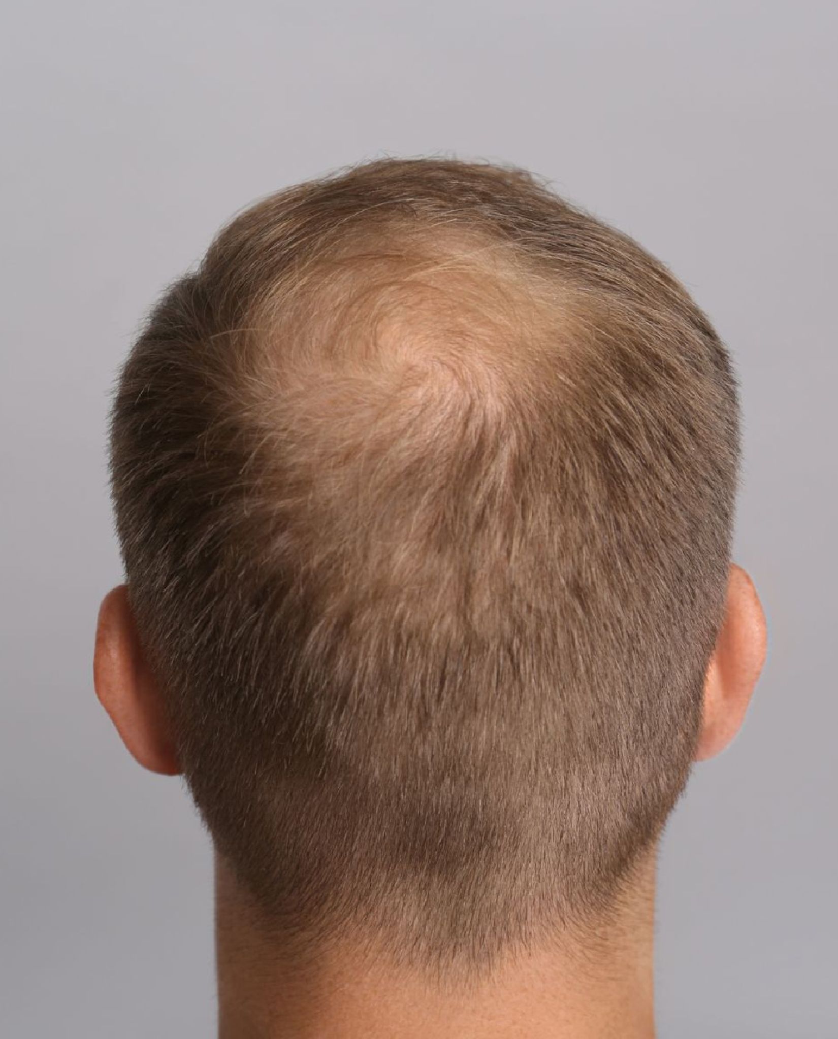 male%20pattern%20bald-d68d053c Folix Hair Restoration - J.Bentley Hair Studio Day Spa | Powell, OH